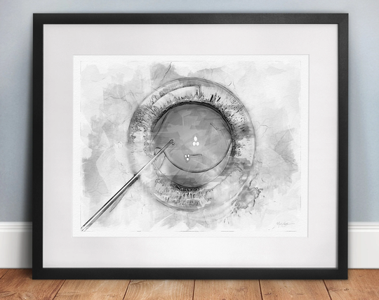 Ophthalmology Art Cataract Surgery Black & White Watercolor-style Sketch Print, A Great Gift For An Eye Doctor - 1305